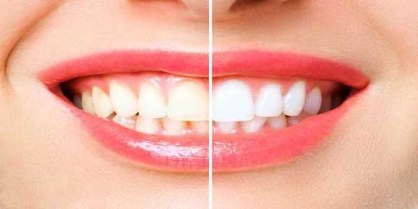 How To Whiten Your Teeth At Home Using Everyday Items