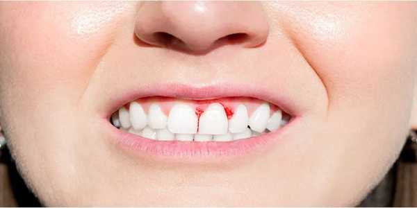 How To Stop Bleeding Gums At Home: Products That Work